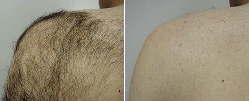 Laser Hair Removal - Piney Point Village City, TX
