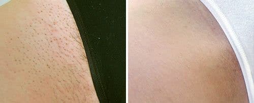 Laser Hair Removal - Meadows Place City, TX