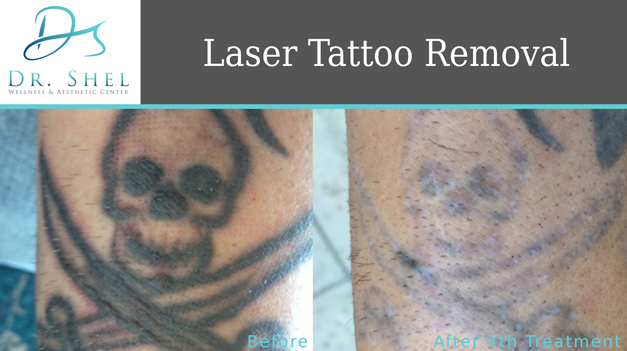 Laser Tattoo Removal - Manvel City, TX