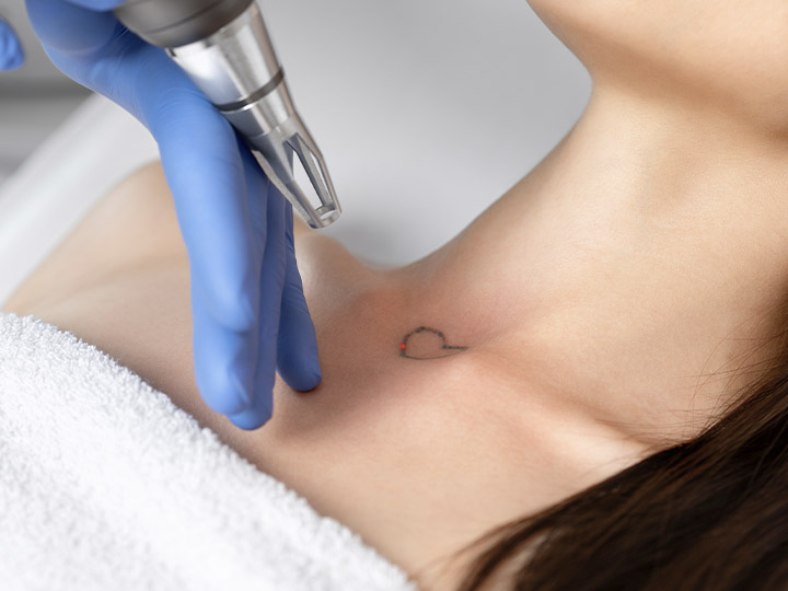 Laser Tattoo Removal - Bellaire City, TX