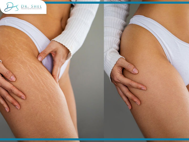 Cellulite Reduction Sugar Land TX