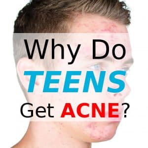 Why Do Teens Get Acne?