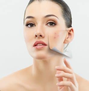 Successfully Eliminate and Prevent Acne Breakouts