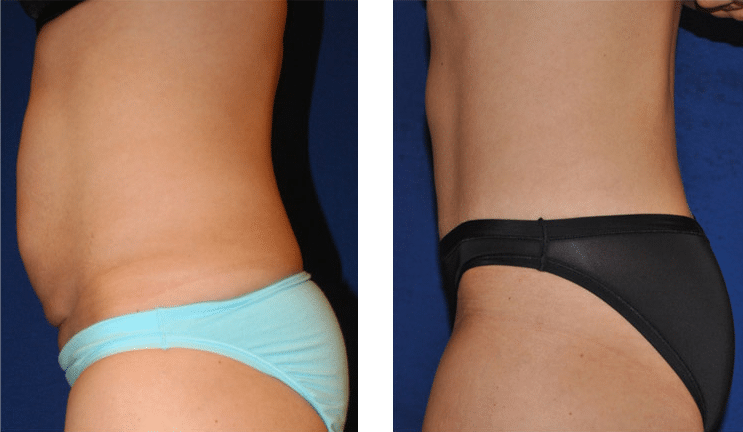 Coolsculpting - before and after
