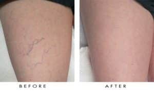 What is the Best Way to Treat Spider Veins?