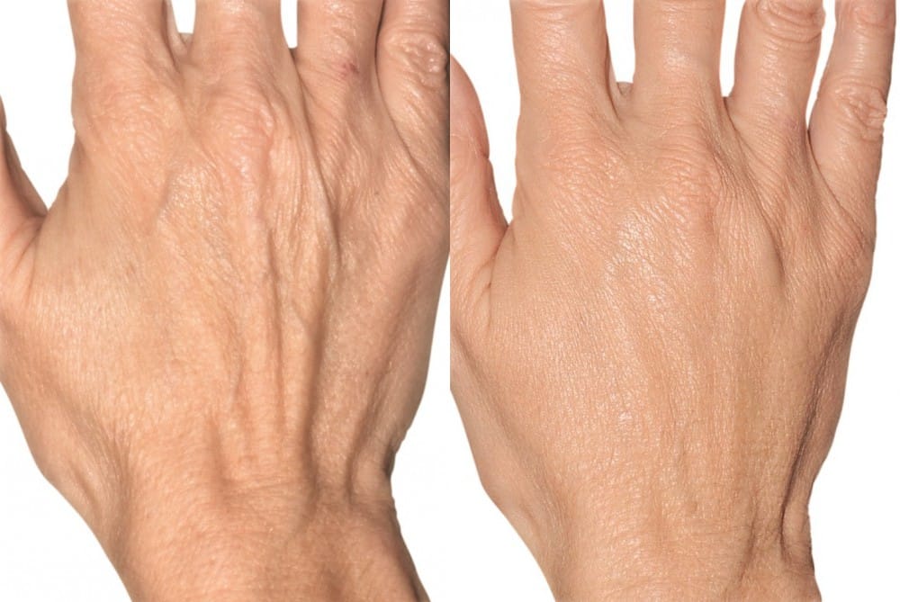 Do Your Hands Give Away Your Age Dr Shel Wellness And Aesthetic Center