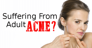 Do You Suffer From Adult Acne? We Have Solutions!