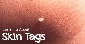 Learning About Skin Tags