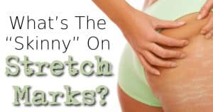 What’s The “Skinny” On Stretch Marks?