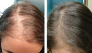 PRP Hair Restoration: What It Is, How It Works & What It Can Do For You