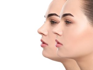 How to Reduce Chin Fat | Dr. Shel Wellness & Aesthetic Center