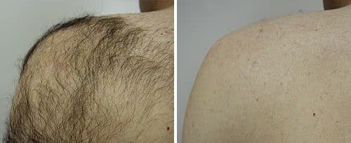 Laser Hair Removal Sugar Land TX