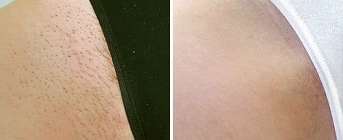 Laser Hair Removal Sugar Land TX