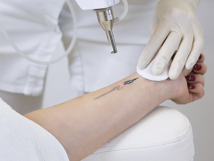 Laser Tattoo Removal is available at Dr. Shel in Sugar Land!